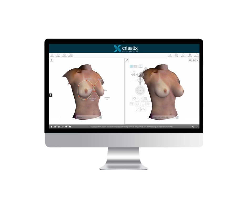 Simulation 3D pour une augmentation mammaire à Reims